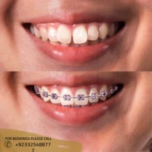 Image of Dental Braces in Islamabad