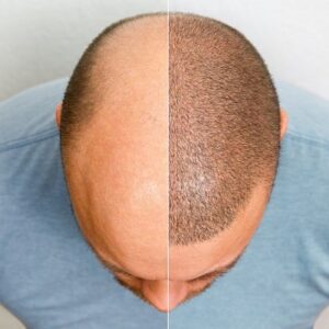 What to expect from a hair transplant in Islamabad