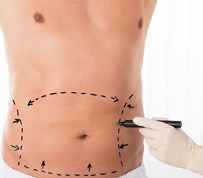 Tummy tuck in Islamabad Pakistan