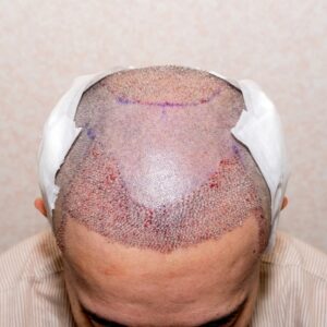 10,000 Grafts Hair transplant Cost in Islamabad Pakistan