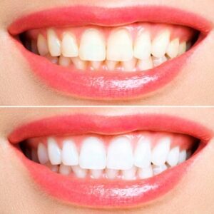 How much does teeth whitening cost in Islamabad?