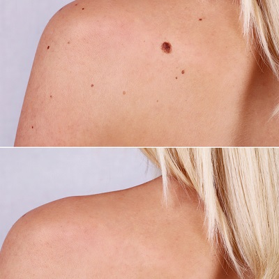 Skin tag removal cost in islamabad