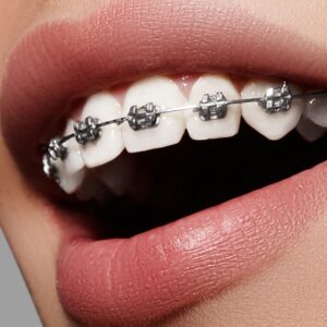 What is the estimated price of dental braces in Pakistan?