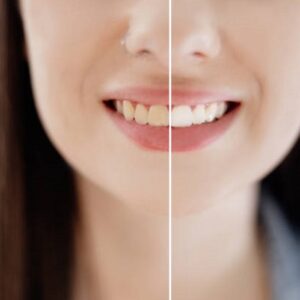 What Are the Benefits and Drawbacks of Teeth Whitening