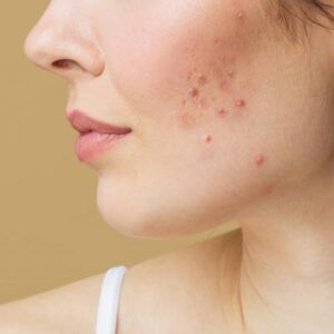 How Microneedling Helps in Getting Rid of Acne Scars?