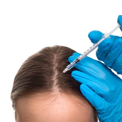 How Is PRP for Hair Treatment Beneficial?