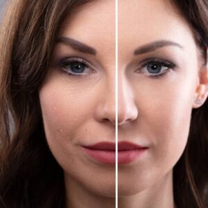 What Is the Best Option for Facelift?