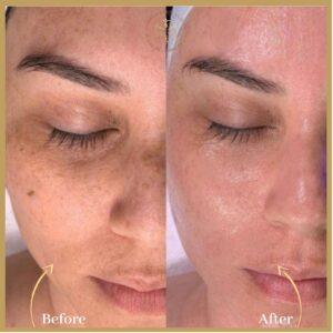 Top 5 Hydrafacial clinics in Islamabad