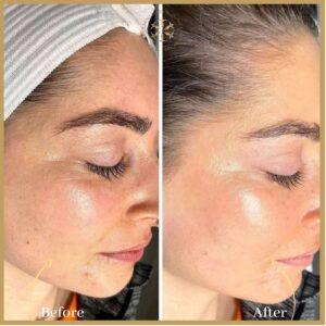 Top 5 Hydrafacial clinics in Islamabad