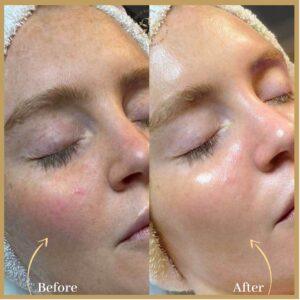 Top 5 Hydrafacial clinics in Islamabad
