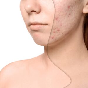 5 best ways to treat acne scars?