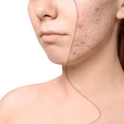 5 best ways to treat acne scars