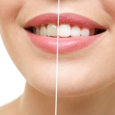 Does Laser Teeth Whitening Affect Tooth Enamel?