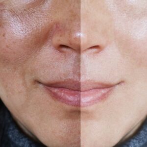 What is the miracle treatment for melasma?