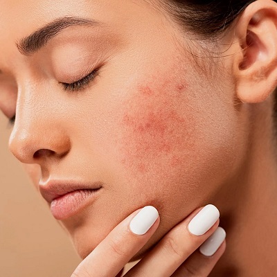 6 Ways to Remove Acne Scars in Islamabad