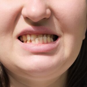 Can I Push My Protruding Teeth Back?