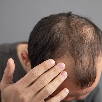 Do Dermatologists Treat Male Hair Loss in Islamabad