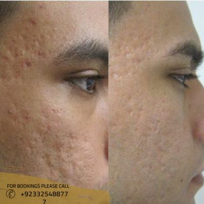 How Radiofrequency Treatment Helps in Removing Acne Scars (1)