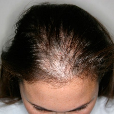 How to Improve Hair Growth for Female Hair Loss