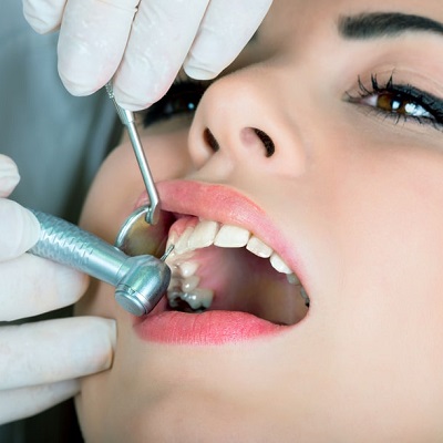 Why Should Dental Filling Need to Be Replaced