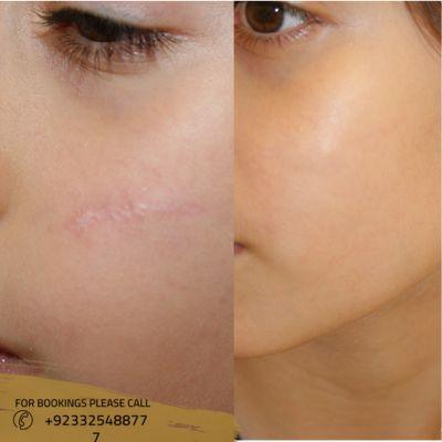 Surgical Scar Revision in Islamabad