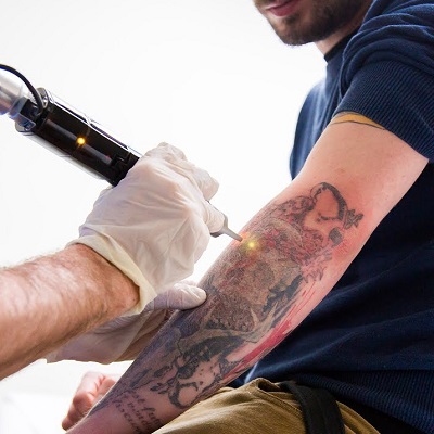 How much does laser tattoo removal cost in Islamabad