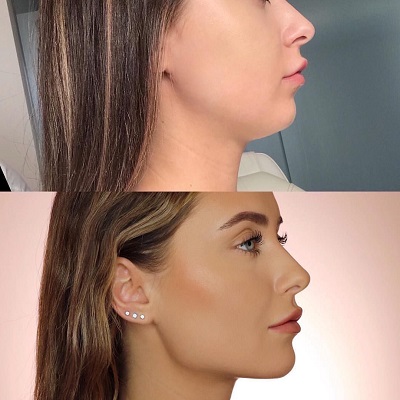 Jawline Contouring in Islamabad