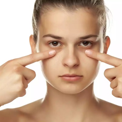 What deficiency causes dark circles treatment in Islamabad under eyes