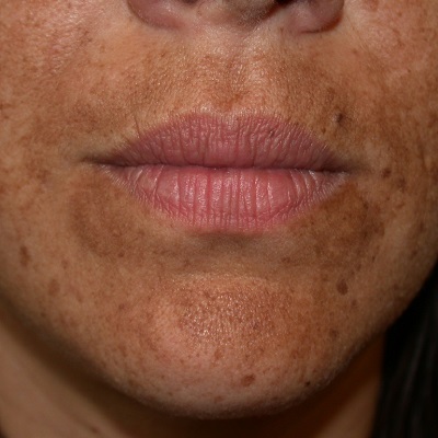 What is the permanent treatment for melasma in Islamabad