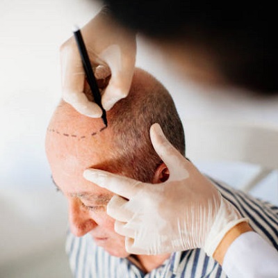 Which Hair Transplant Surgery Is Best in Islamabad