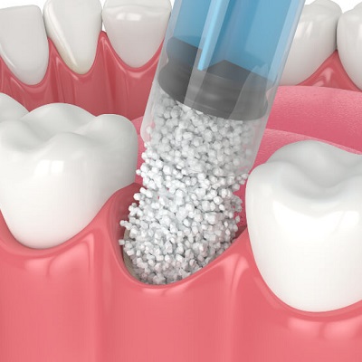 How Much Does Bone Grafting Cost in Pakistan?