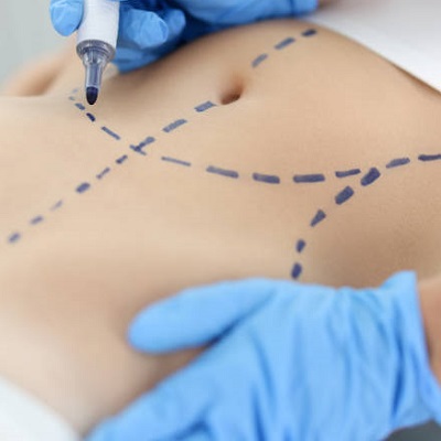 Is Liposuction a Good Way to Lose Weight?