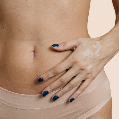 Which One Is Cheaper Tummy Tuck or Liposuction?