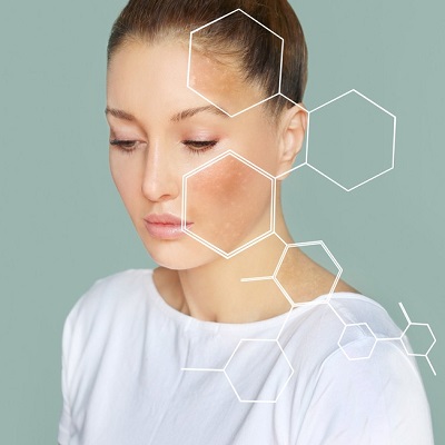 Can Melasma Disappear on Its Own?