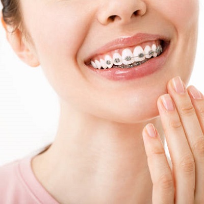 How much do braces cost in Islamabad?