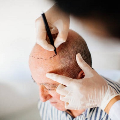 What Would Be the Reason for a Second Hair Transplantation?