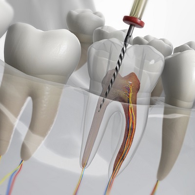 Why do root canals have to be redone?