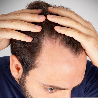 Are There Any Side Effects from Hair Loss Treatments?