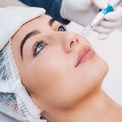 Can microneedling improve dark circles?