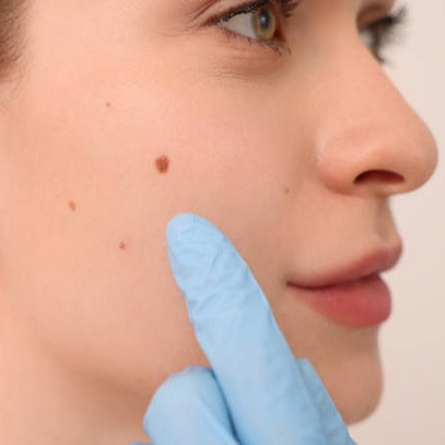 How long does it take to remove a birthmark?