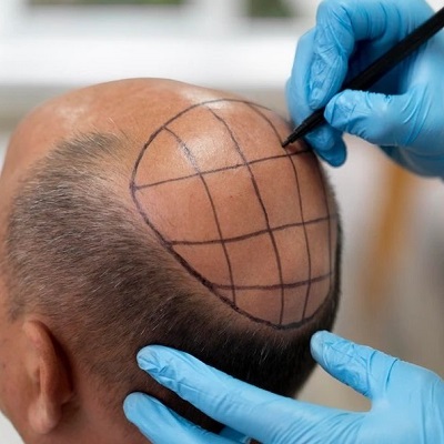 How painful is hair transplant surgery in Islamabad?