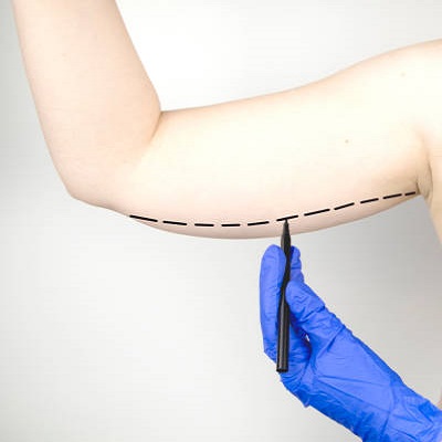 How soon can I tone my arms after brachioplasty?