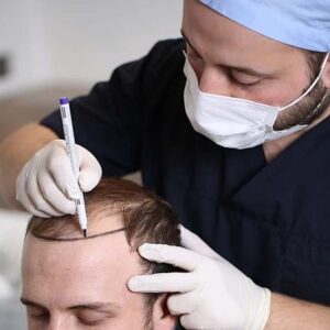 What Happens 5 Years After A Hair Transplant?