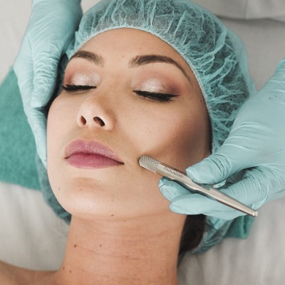 Can I do mesotherapy if I have acne?