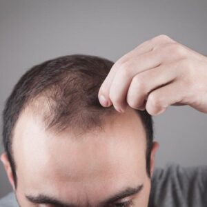 Is It OK to Cut Hair After Hair Transplant?