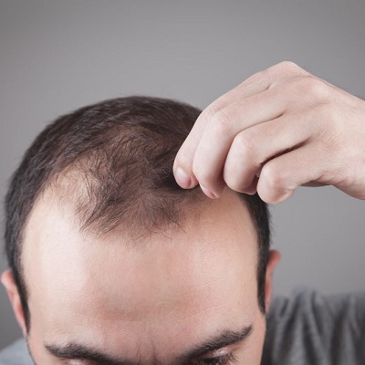 Is It OK to Cut Hair After Hair Transplant?