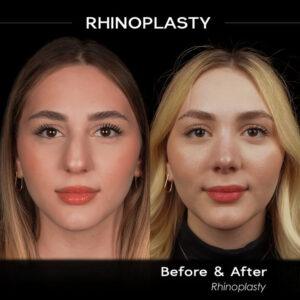 rhinoplasty before and after 