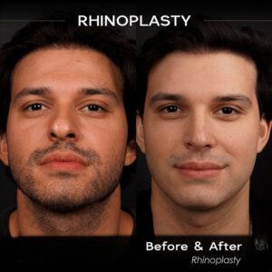 rhinoplasty before and after 