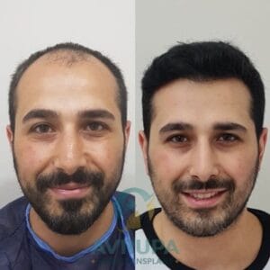 Results of Hair Transplant in Islamabad, Pakistan