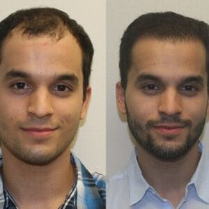 Results of Hair Transplant in Islamabad, Pakistan